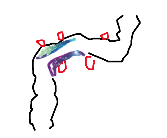 Colonic diverticulosis