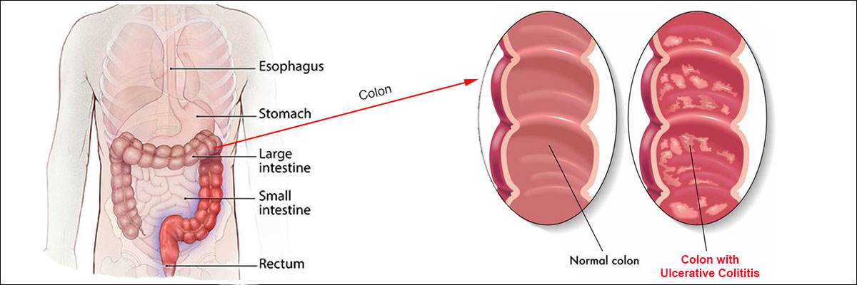 Ulcerative colitis