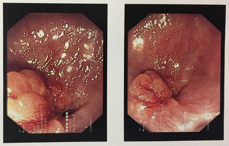 stomach cancer symptoms