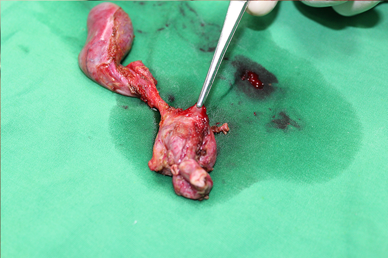 Choledocal cyst case study