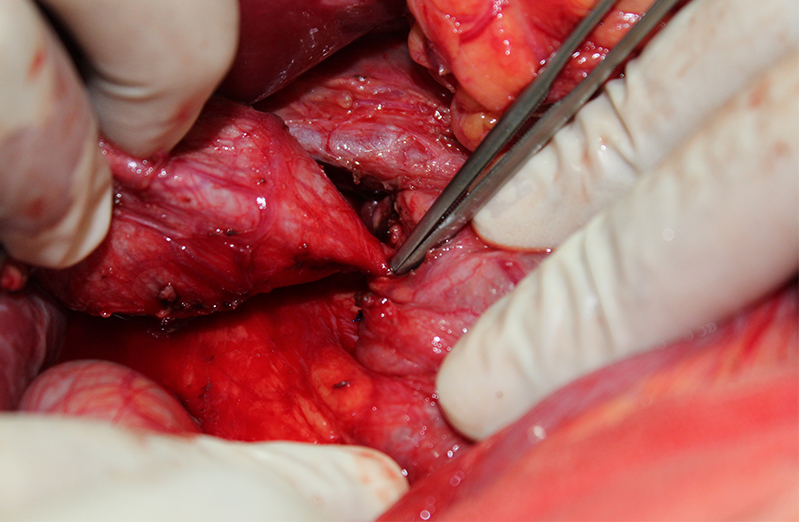 Choledocal cyst surgery