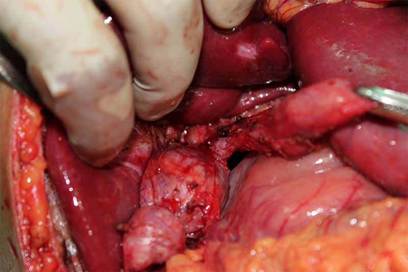 Choledocal cyst treatet