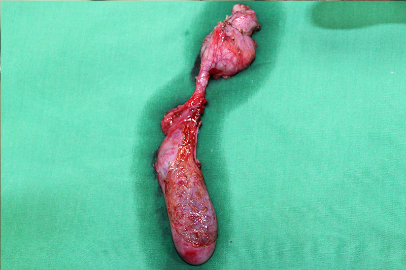 Choledocal cyst treatment mumbai