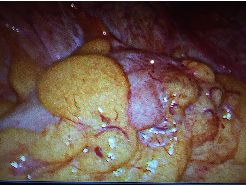 Diverticular disease