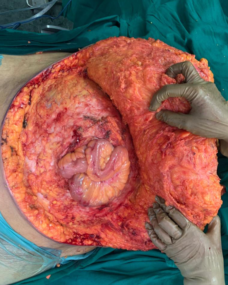 Giant Midline Abdominal Wall Hernias