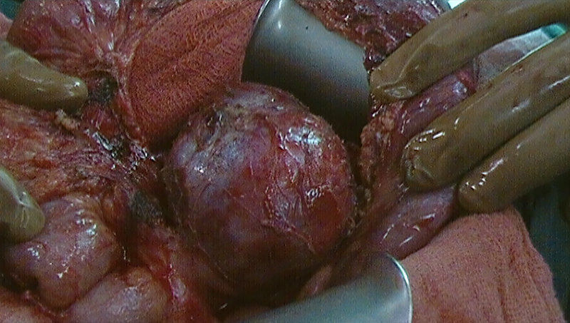Mesenteric Tumors Treatment
