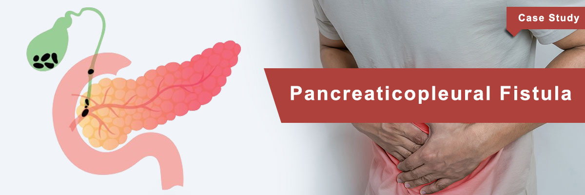 Pancreaticopleural Fistula Pancreaticopleural Fistula