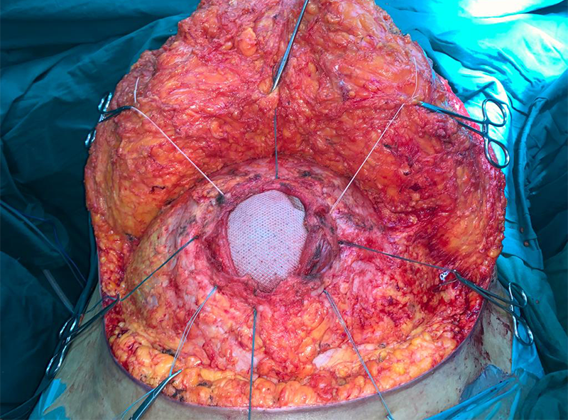 abdominal wall hernia