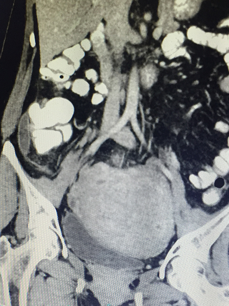 acute appendicitis case study