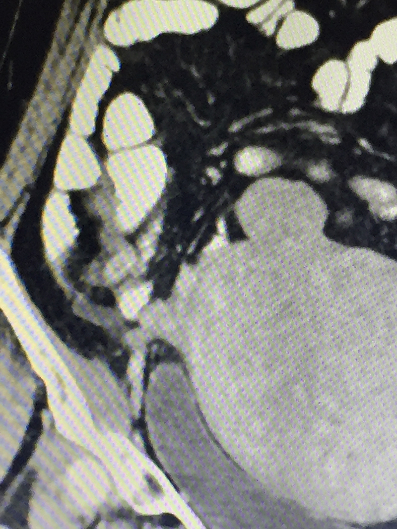 acute appendicitis complications