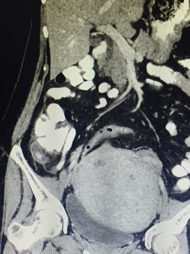 acute appendicitis treatment