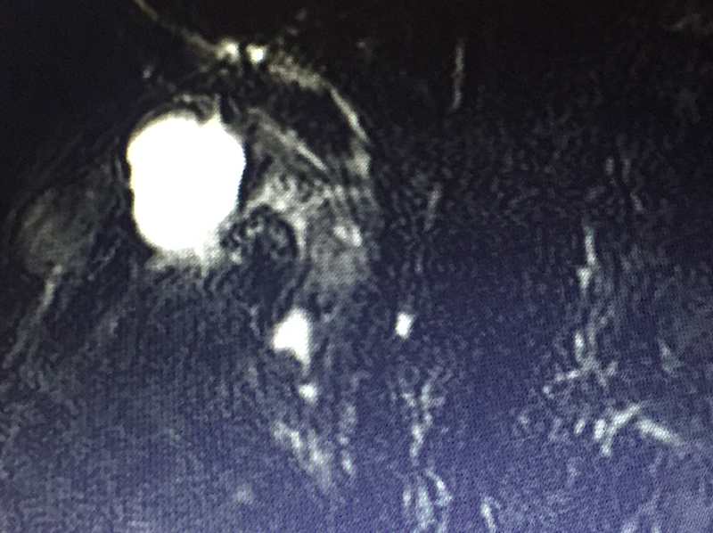 acute cholecystitis treatment