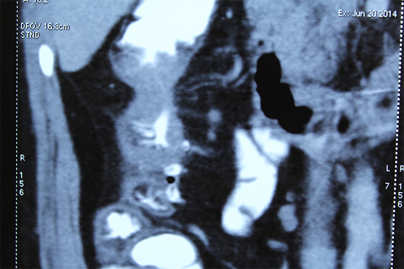 advanced colon cancer