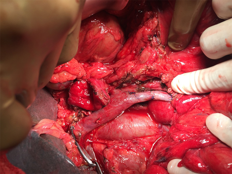 chronic pancreatitis