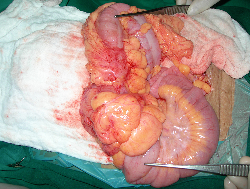 colon cancer treatment