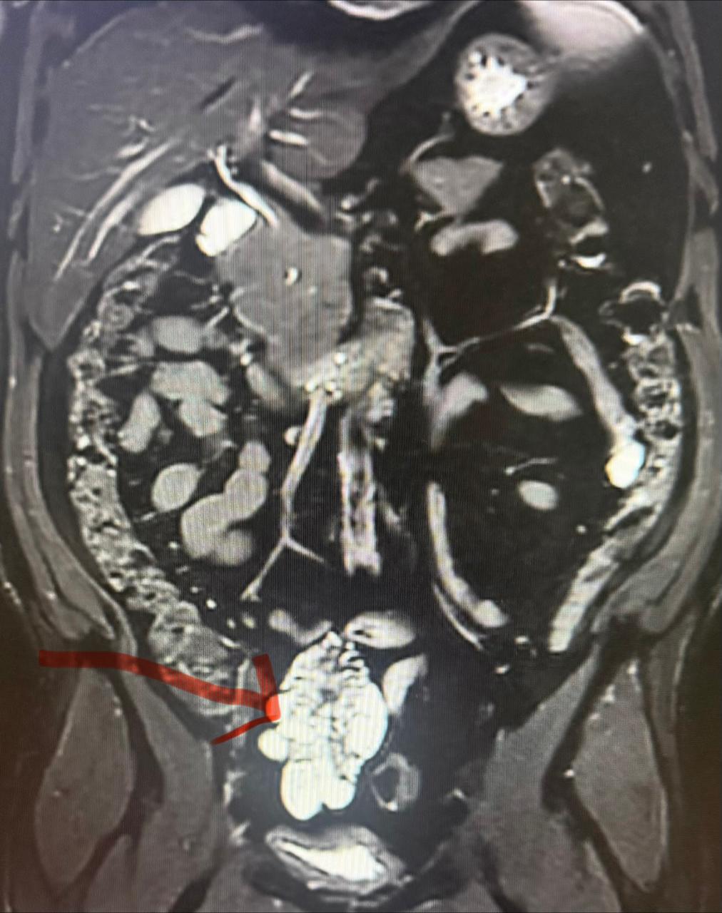 Coronal MRI showing a mesenteric lymphangioma involving the terminal ileum with associated bowel narrowing.