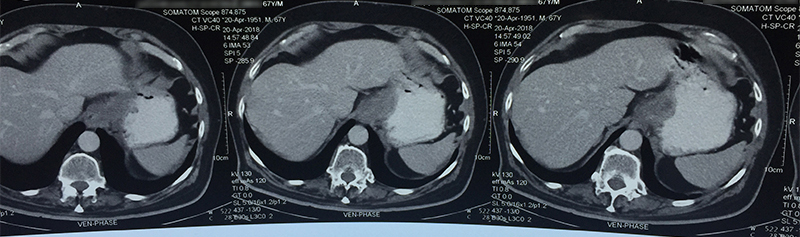 stomach cancer causes