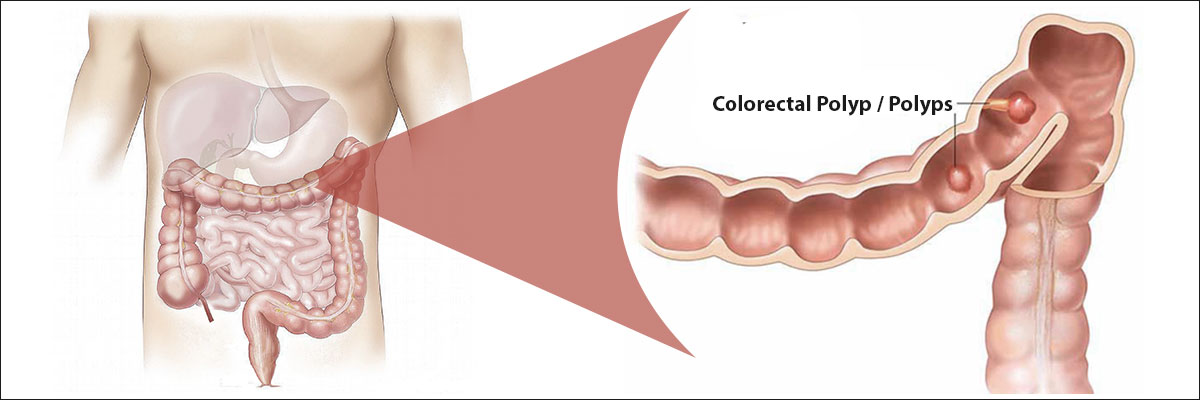 Colorectal polyps